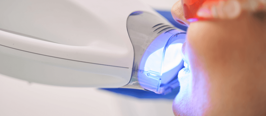 Laser Teeth Cleaning 1