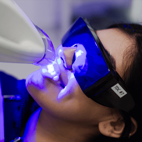 Laser Teeth Cleaning