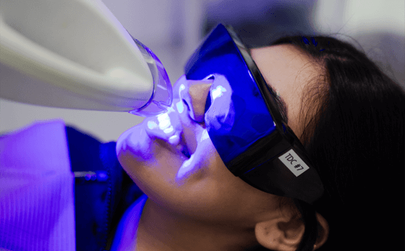Laser Teeth Cleaning