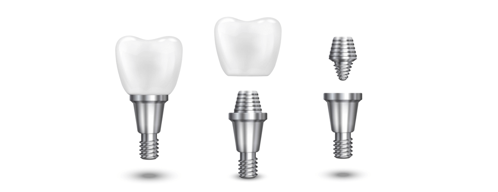 Discover the Top-Rated Dentist in Tijuana for Implants and Dental Crowns 3