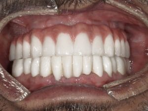 image of teeth after a dental implant