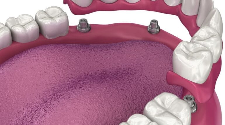 image of teeth after a dental implant in Tijuana