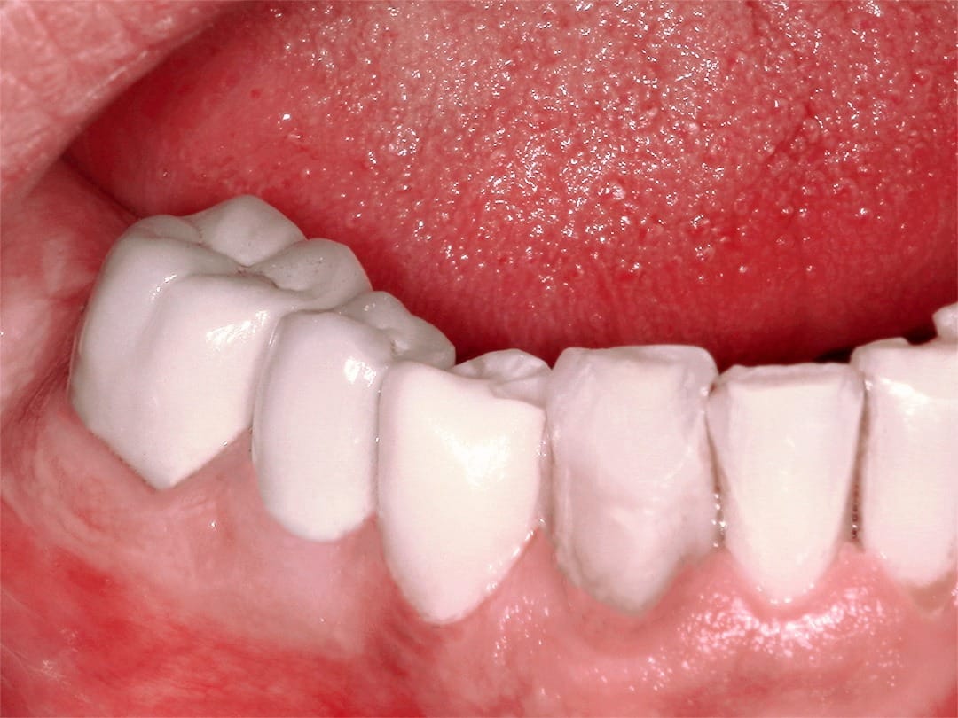 Porcelain Dental Crowns in Tijuana