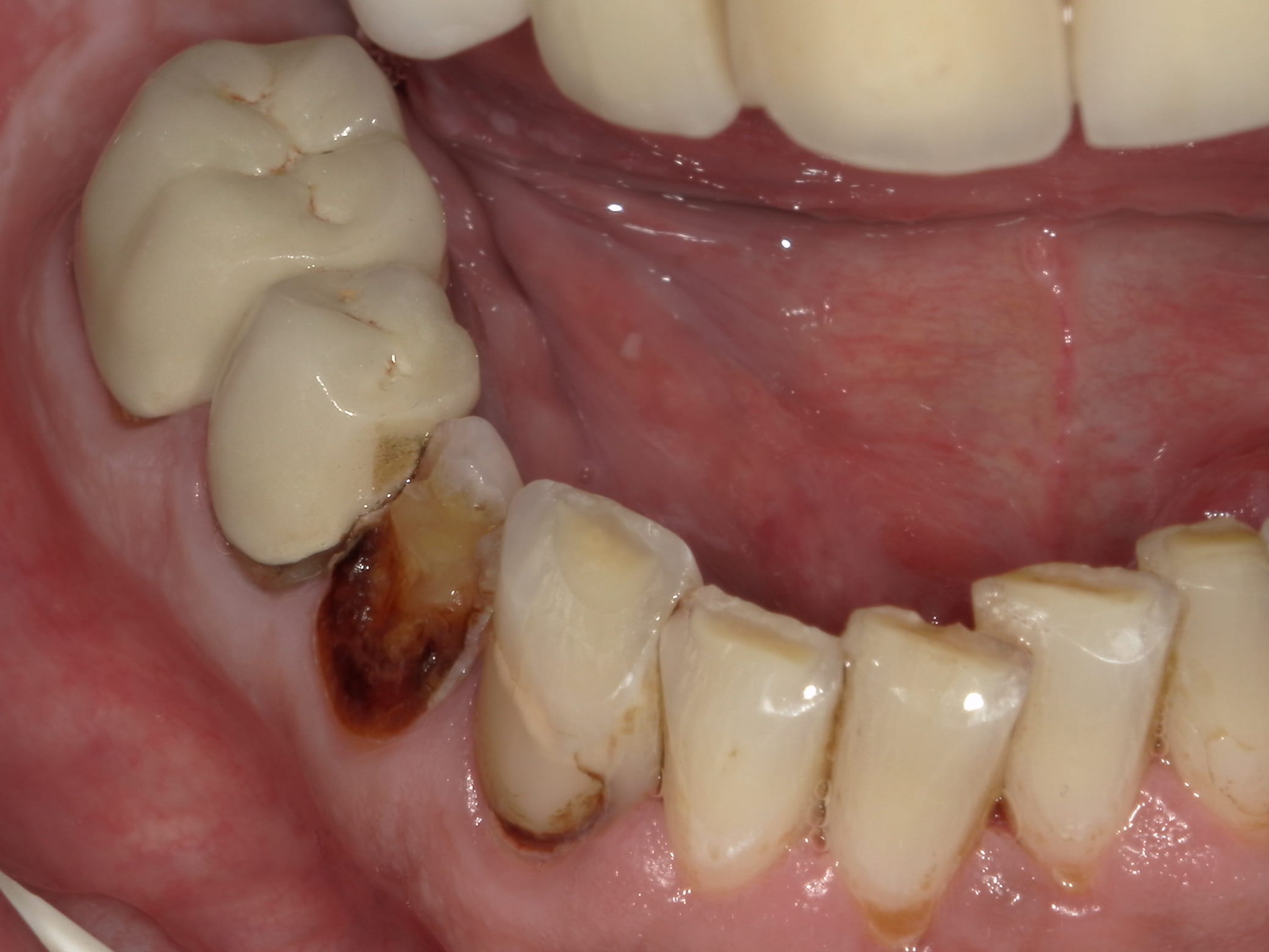 dental bridge preparation