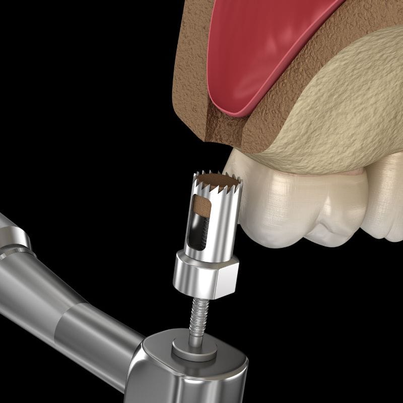 Phase 1 Bone Graft