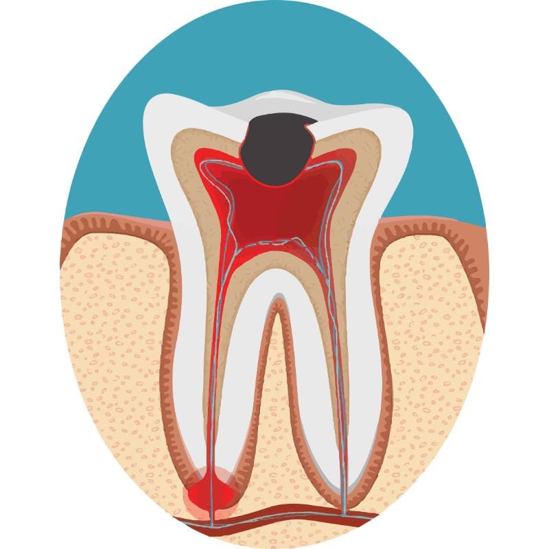 Laser tooth preparation