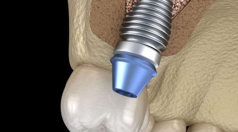 Phase 3 Bone Graft