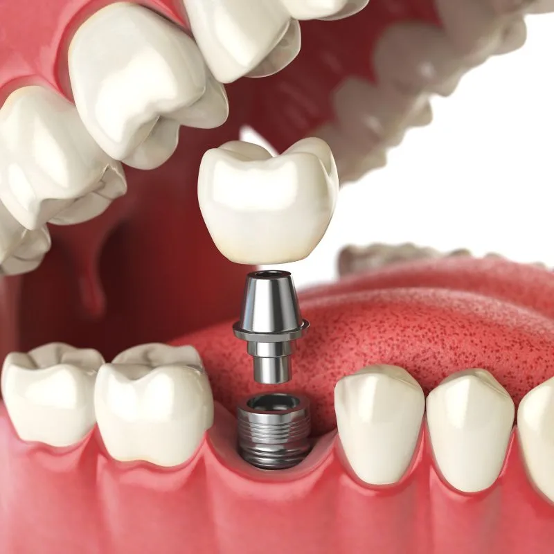 image of teeth after a dental implant