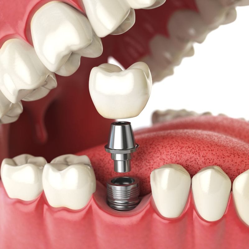 Dental Implants in Tijuana