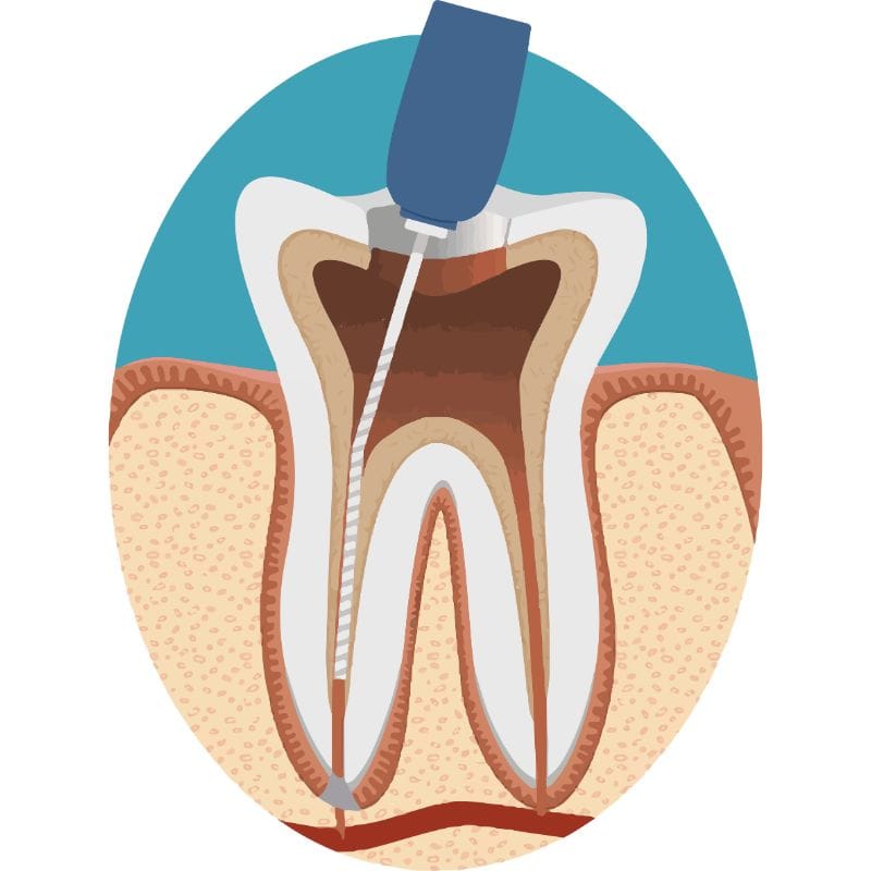 Porcelain veneers result