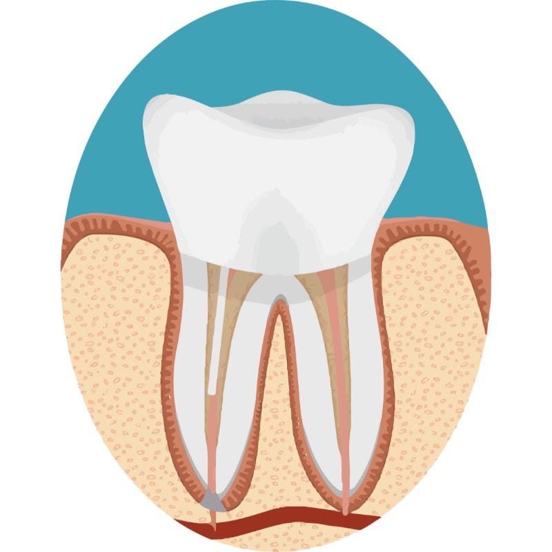 Porcelain veneers result