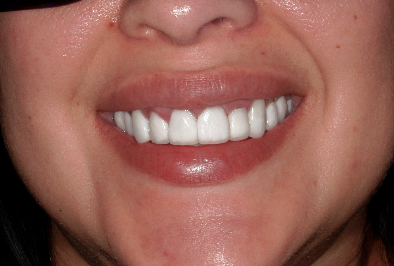 Best Teeth Whitening Tijuana