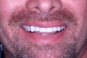 Best Teeth Whitening Tijuana