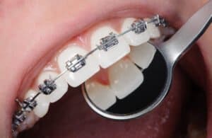 orthodontics in tijuana