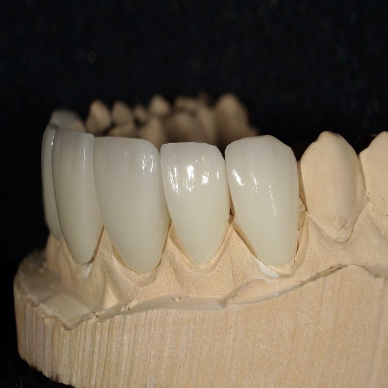 Image of teeth after veneers with black backgorund