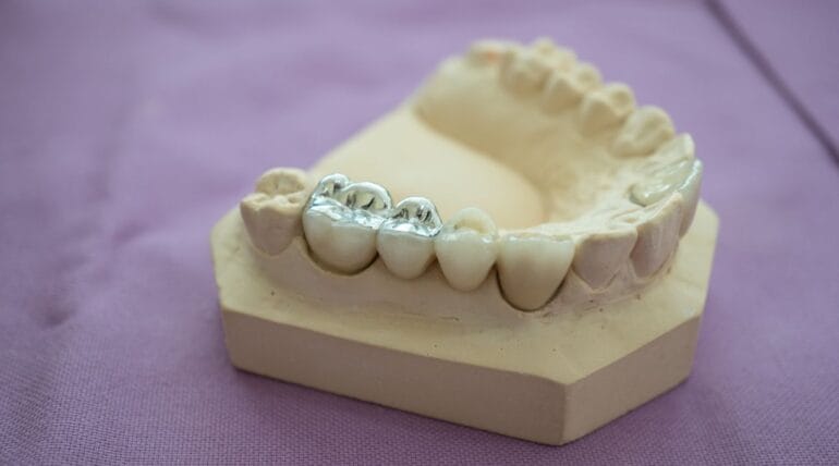 Amalgam Fillings