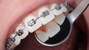 Dental Braces in Tijuana