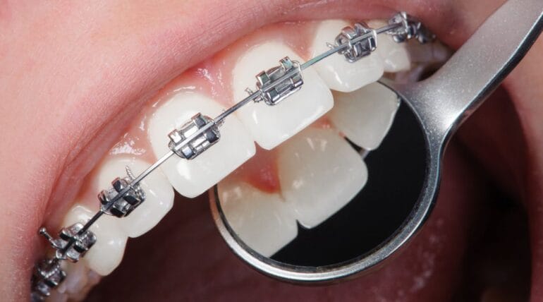 Dental Braces in Tijuana