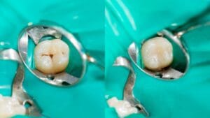 Composite Fillings