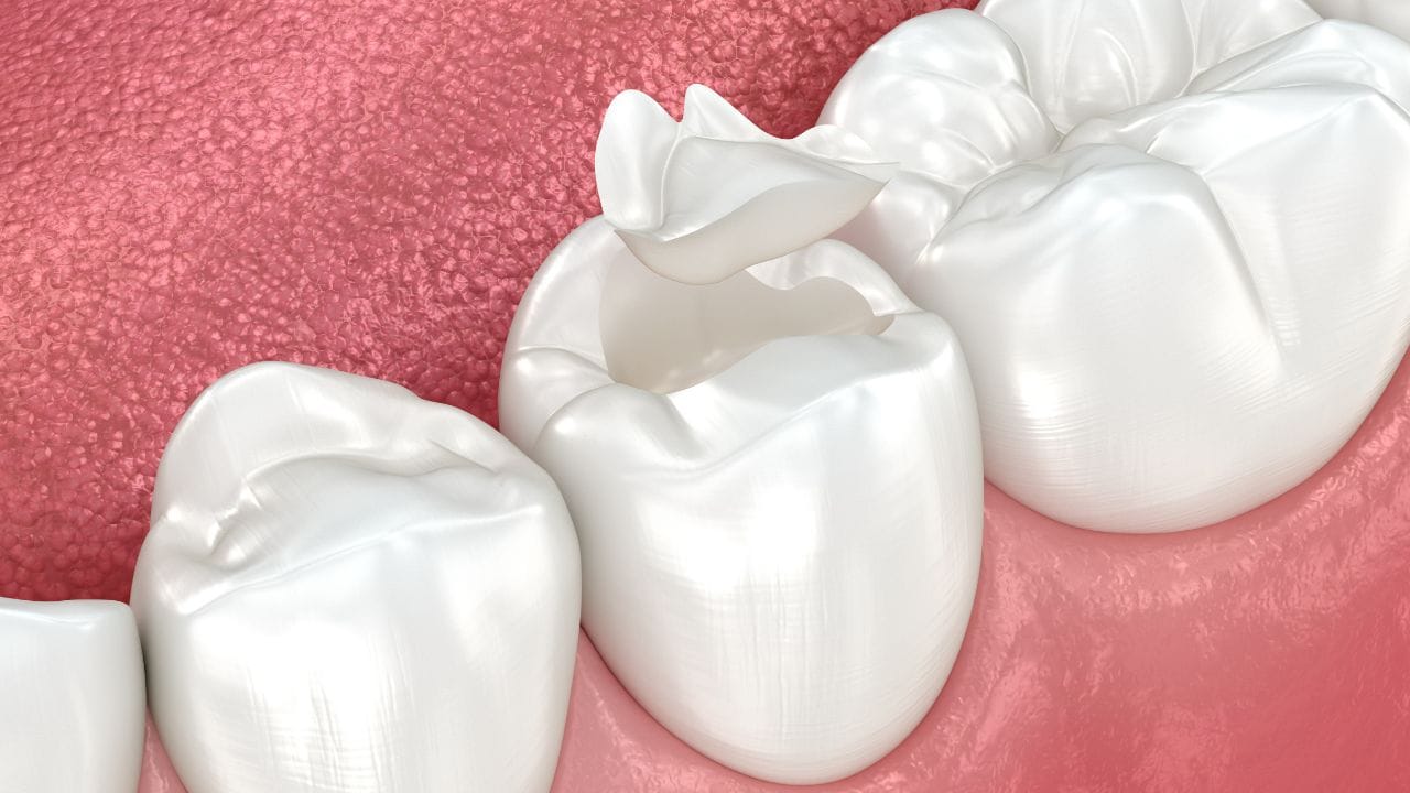 Restorations with dental resin in Tijuana