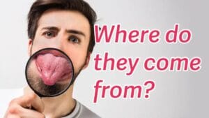 Lingual Papillitis