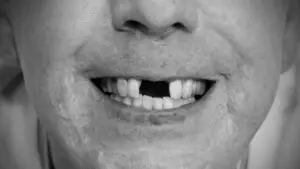 Missing Teeth average cost of dental implants
