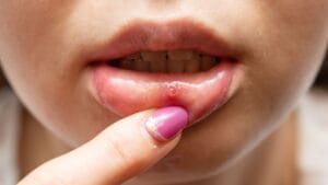 Mouth Ulcers