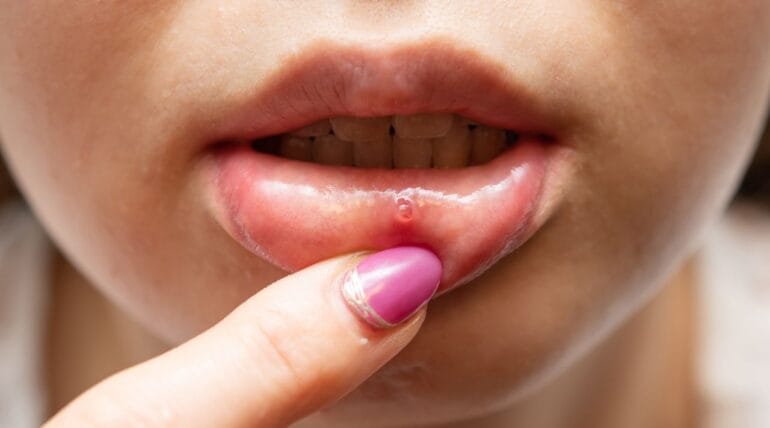 Mouth Ulcers