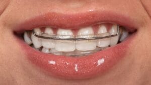 Permanent Retainer