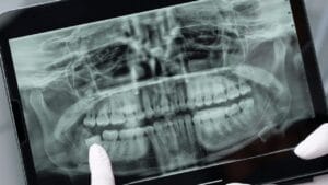 Root Canal Diagnosis root canal dentist near me