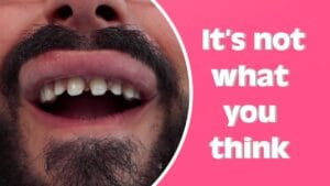 Dental Veneers Shavin 00
