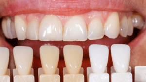 Uveneers vs. Porcelain Veneers a Cheap Alternative