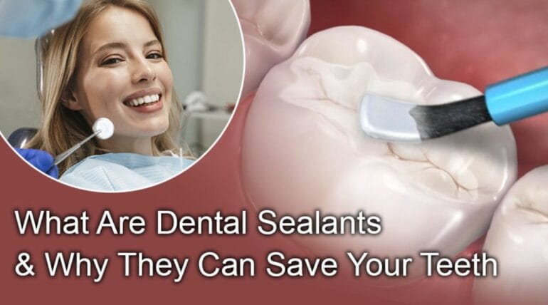 What are Dental Sealants