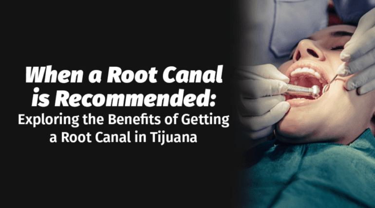 root canal