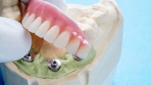 All on 4 Implants