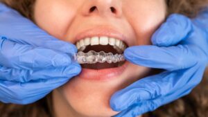 How to Clean mouthguard