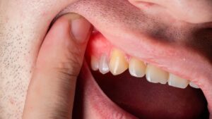 Gingival Cyst