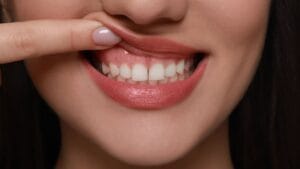 Gum Smile