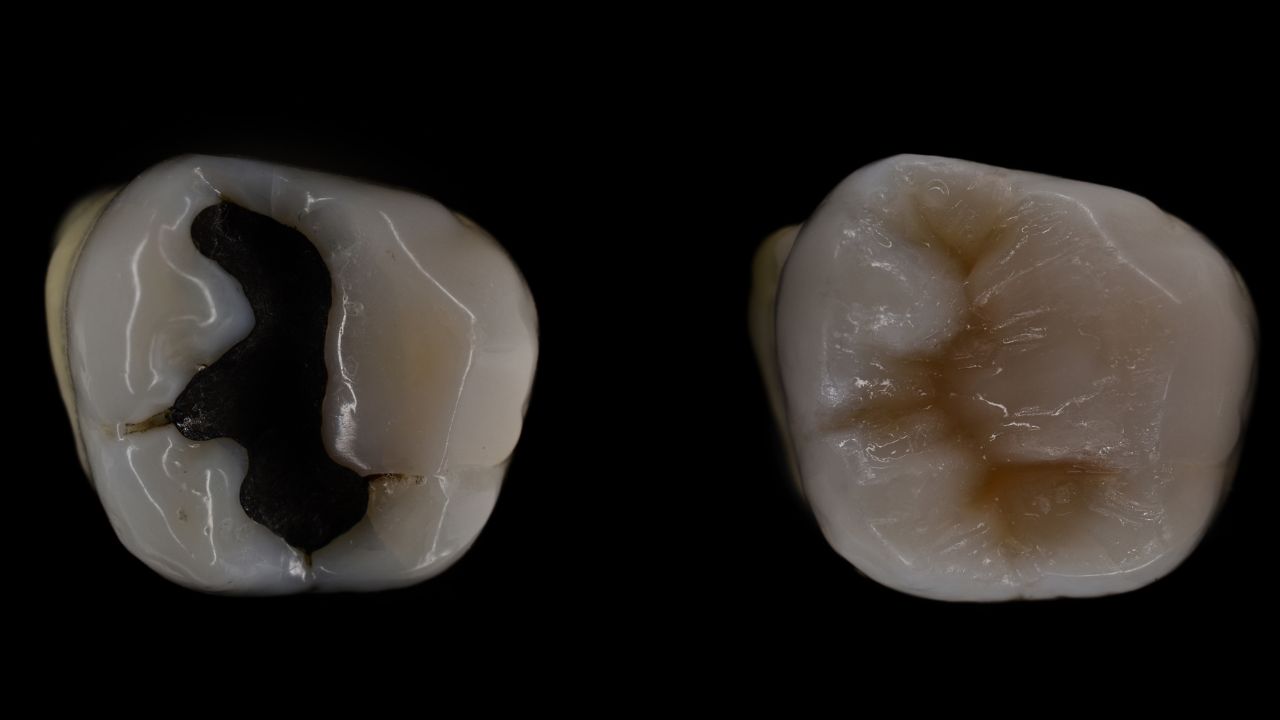 Mercury Amalgam Fillings