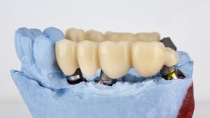 Missing Tooth Dental Bridge