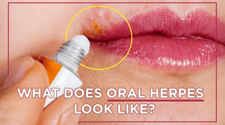 Oral Herpes