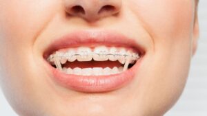 Orthodontics Elastics