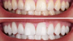 Teeth Shaving