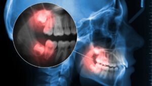 Wisdom teeth coming