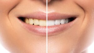 Yellow Teeth Treatment
