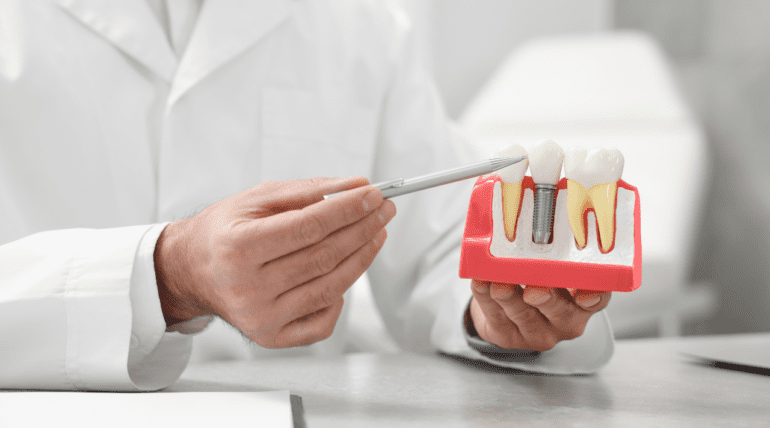 dental implants Types of Implants