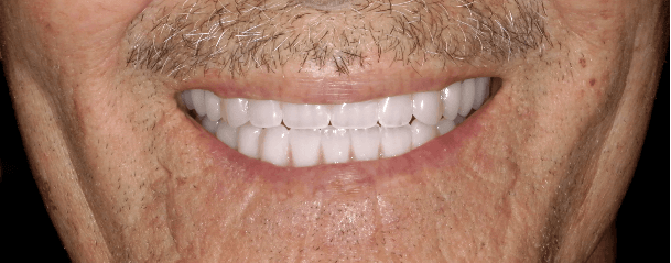 ALL ON 6 DENTAL IMPLANTS IN TIJUANA