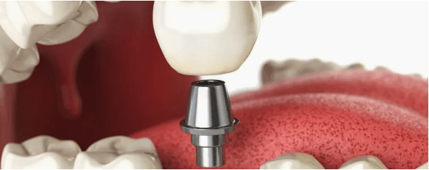 dental implants