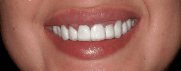 DENTAL VENEERS IN TIJUANA