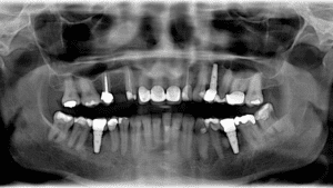 8 signs that you need dental implants